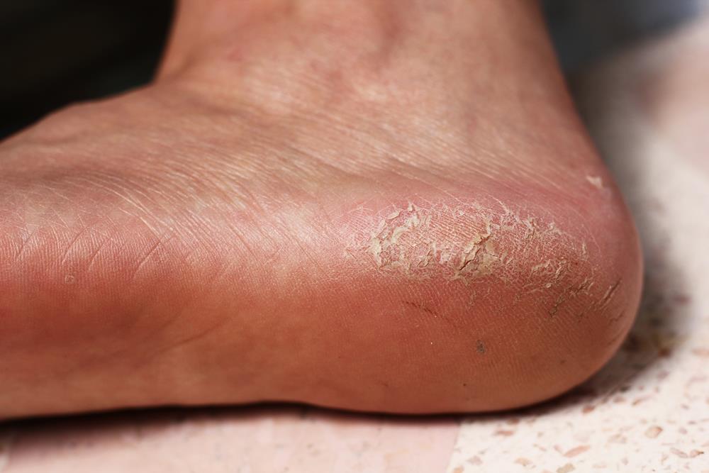 Calluses  Taylor, MI 